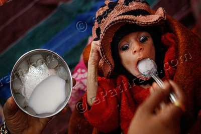 malnutrition-children-india-epathram