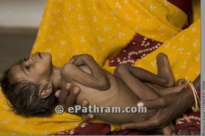 Malnutrition-India-epathram